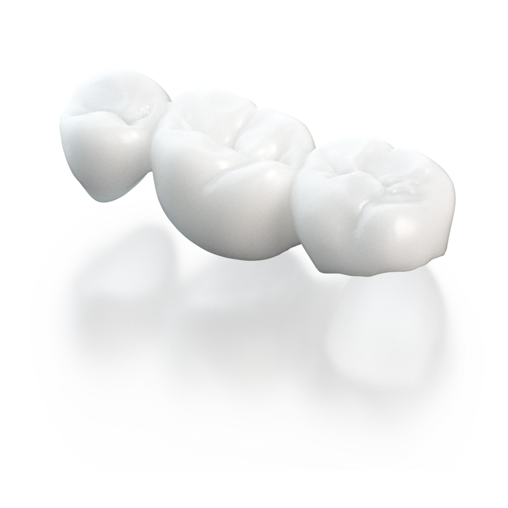 Tandbro printet med SprintRay DigitalTemp resin